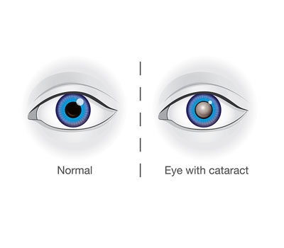 Cataract