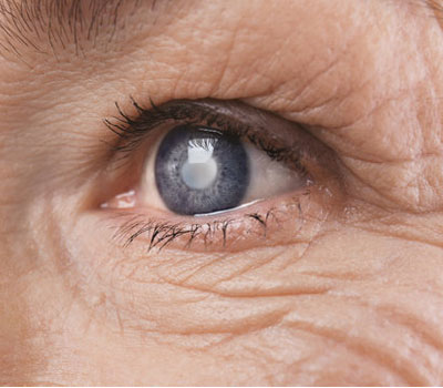 Glaucoma