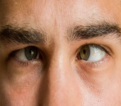 Squint Eye