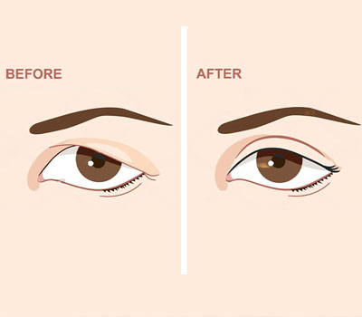 Oculoplasty
